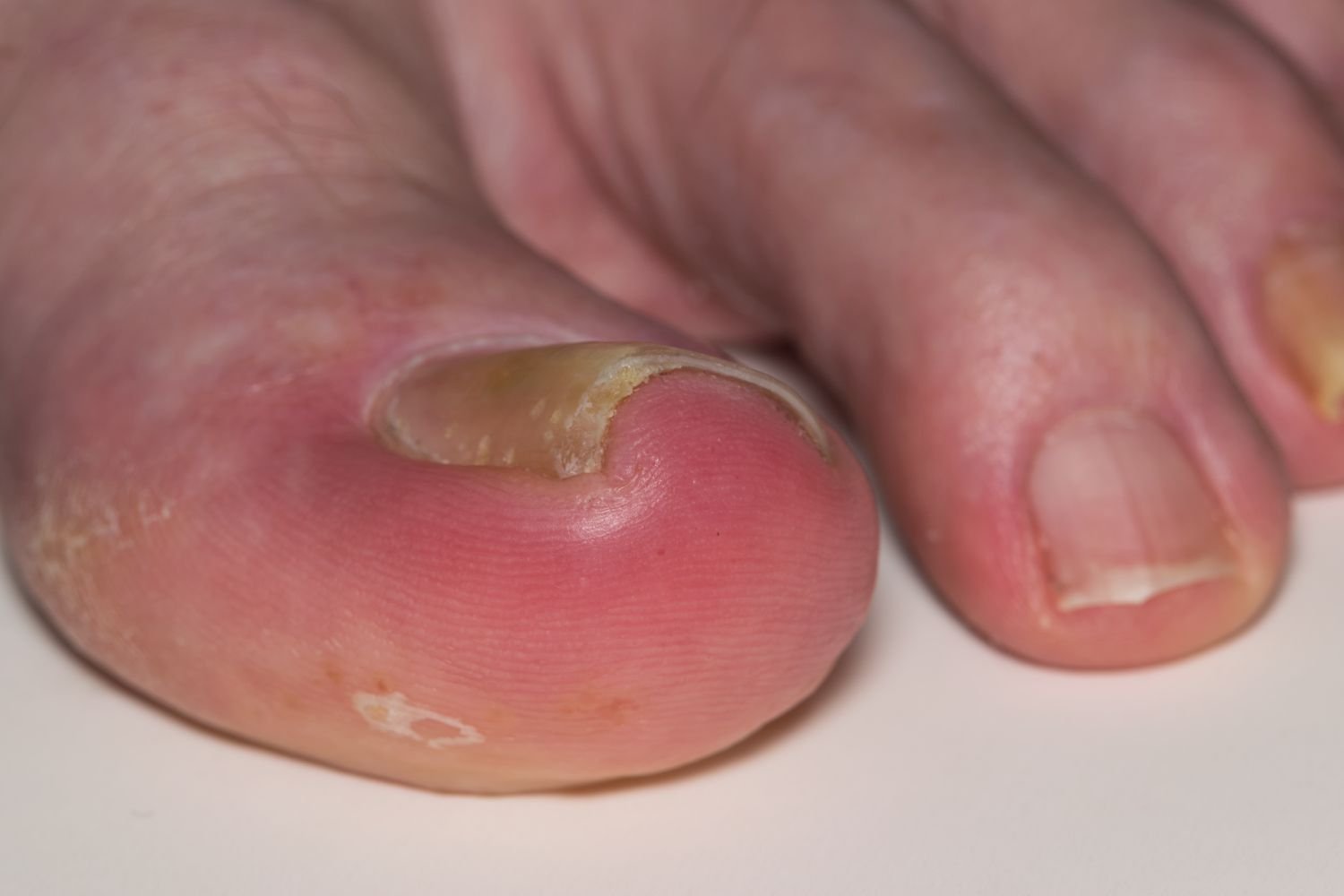 Ingrown toenail