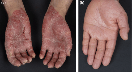 Palmar-psoriasis-before-and-after