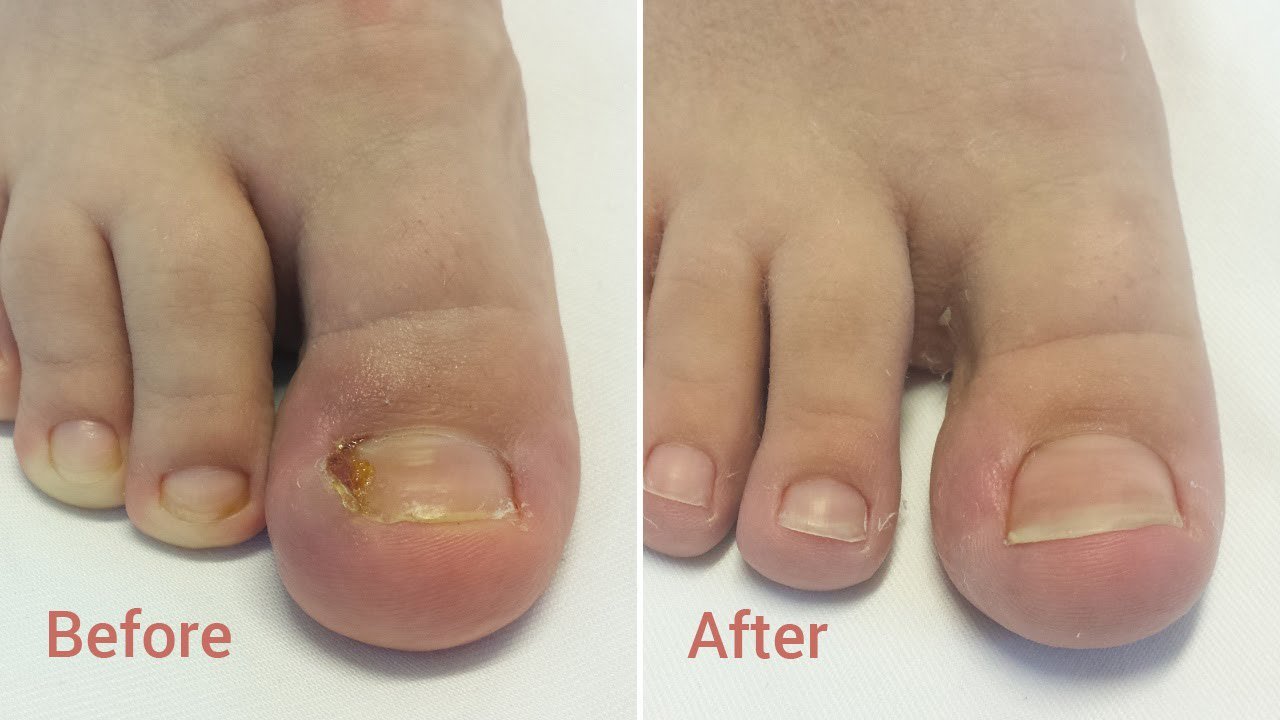 before and after ingrown toenail