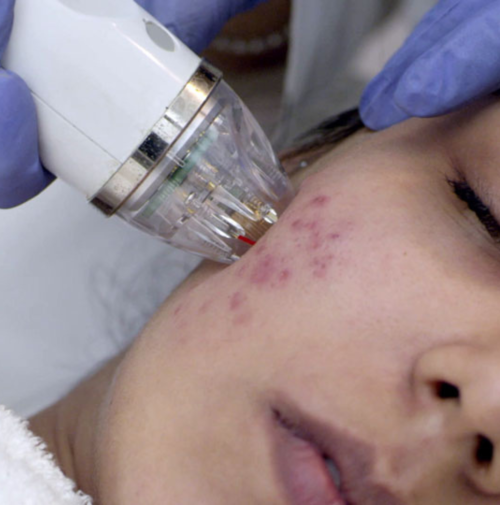 Acne-Scar-Treatment Acne-Scar-Treatment