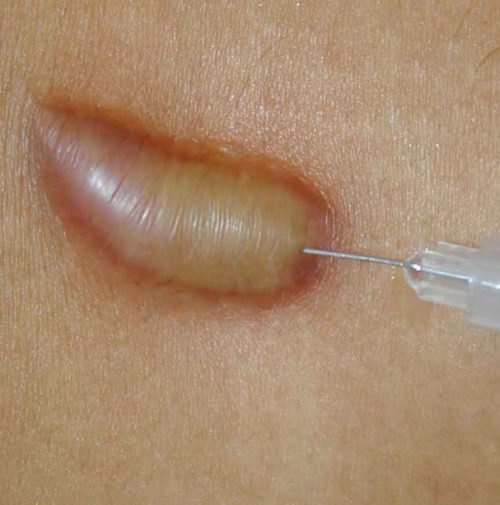keloid treatment keloid treatment