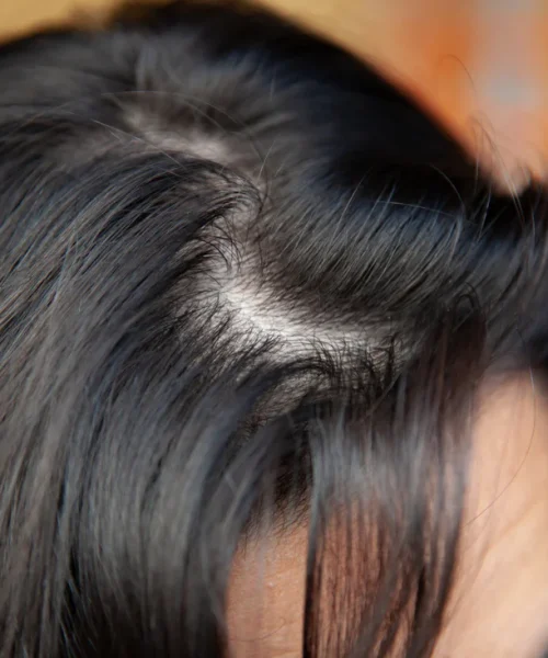 what-does-thinning-hair-look-like what-does-thinning-hair-look-like